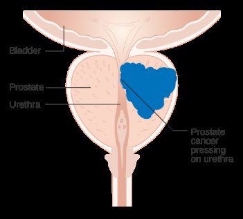 Diagram showing prostate cancer