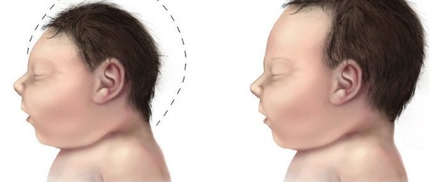 Microcephaly comparison