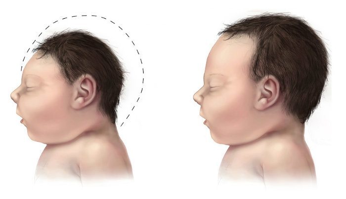 Microcephaly comparison