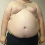 Being Obese May Not Mean You Are Unhealthy